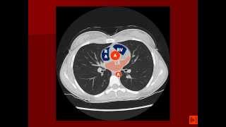 Normal Chest CT with labels [upl. by Aynat808]