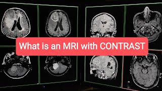 What is an MRI with Contrast  Explained in details in English [upl. by Datnow]