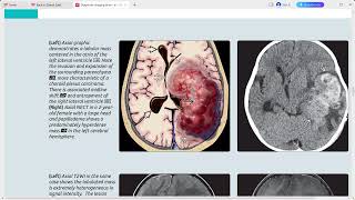 NEOPLASMS BRAIN DIAGNOSTIC IMAGING SERIES [upl. by Amesari]