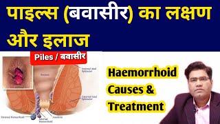 What Are Piles HEMORRHOIDS Causes Symptoms and Treatment  in Hindi [upl. by Nomit]