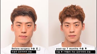 Facial Asymmetric Double Jaw Surgery Review Post OP 7 MonthsEU Korea [upl. by Chaille697]