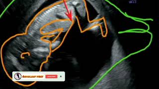 Right side movement Baby Boy Baby boy on ultrasound Radiology vibes [upl. by Atsylak]