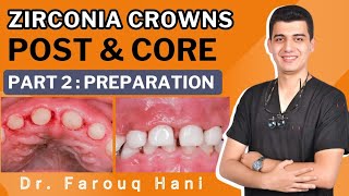 Zirconia crowns  Post amp core in children part 2 PREPARATION [upl. by Macgregor422]