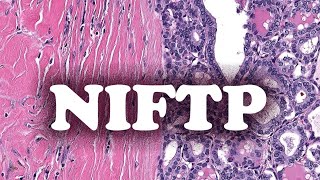 LE NEOPLASME FOLLICULAIRE AVEC CARACTERISTIQUES NUCLEAIRES PAPILLAIRESLIKE NIFTP  PATHOLOGIE [upl. by Valtin430]