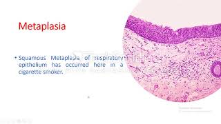 Cellular adaptation Metaplasia [upl. by Tnomel34]