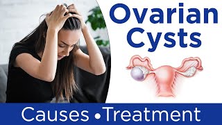 ❇️ What are Ovarian Cysts  💹Ovarian Cysts Symptoms Causes And Treatment in Hindi [upl. by Nnagem]