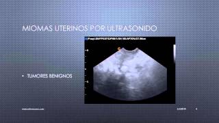 MIOMAS UTERINOS VISUALIZADOS POR ULTRASONIDO [upl. by Nywled]