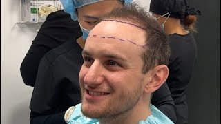 How to decide Hair transplant hairline height [upl. by Claudius]