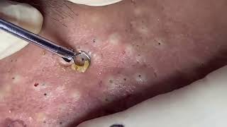 blackheads New this week 2023 [upl. by Amling]