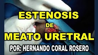 ESTENOSIS DE MEATO URETRAL  ESTRECHAMIENTO DEL ORIFICIO DE LA URETRA [upl. by Herbst201]