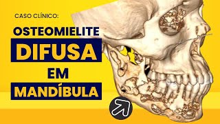 Reabsorção óssea mandibular difusa Uma osteomielite é capaz disso [upl. by Maegan525]