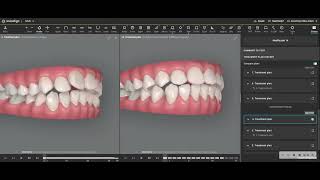 Severe Overjet Reduction with Invisalign and IPR [upl. by Tavia]