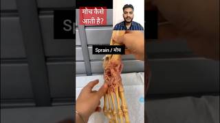 sprain मोच कैसे आती है how sprain occur shorts viral medical illness health [upl. by Paapanen]