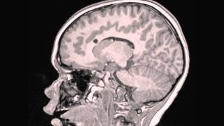 Tuberous Sclerosis [upl. by Nirrac]