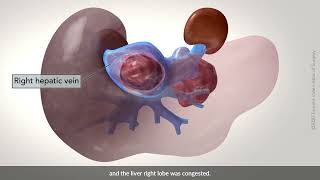 Right hepatectomy with cava resection and oophorectomy [upl. by Drummond]