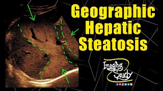 Geographic Hepatic Steatosis  Focal Fatty Infiltration  Ultrasound  Case 159 [upl. by Loree154]