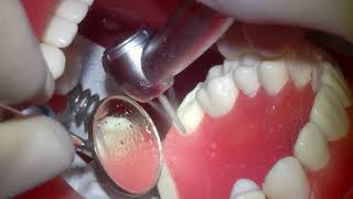 치아삭제 실습 2 17 Tooth preparation for metal crown [upl. by Aliuqat]