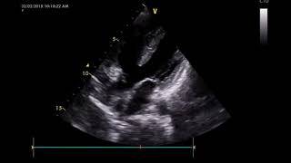 Tetralogy of Fallot TOF [upl. by Nilekcaj435]