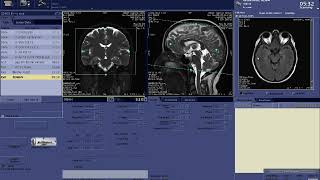 BRAIN MRV Planning with GE Scanner [upl. by Aittam]