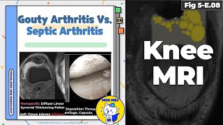 Fig 5E08 Acute Gouty Arthritis vs Septic Arthritis [upl. by Eidod]