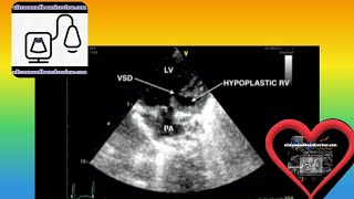 Hypoplastic Right Heart Syndrome [upl. by Rowena884]