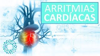 ARRITMIAS CARDIACAS – Síntomas y Tratamientos Arritmias [upl. by Lehman504]