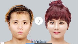 Korea plastic surgery Best Korean Plastic Surgery Clinics  two jaw surgery with 3D printer [upl. by Arimas]