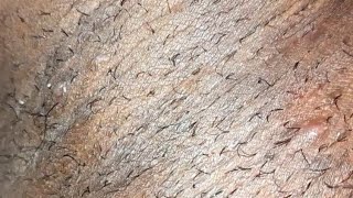 infected ingrown hair removal viral asmr ingrownhair trending hairremoval [upl. by Oer]