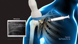 Hip Pain Overlying the Greater Trochanter Bursa [upl. by Gnat]