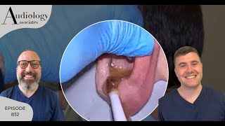 IRRIGATION OF HARD EAR WAX PLUG amp STUCK OTIP EXTRACTION EP832 [upl. by Nednil111]