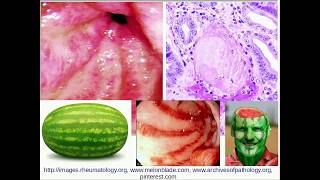 Histopathology  Gastric Antral Vascular ectasia GAVE [upl. by Llehsyar]