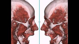 Articulación Temporo Mandibular ATM a través de TC 4D [upl. by Reeva]