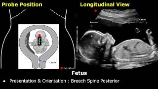 Obstetric Ultrasound Probe Positioning  Pregnant Uterus amp Fetus Transducer Placement USG Scan [upl. by Nirrad]