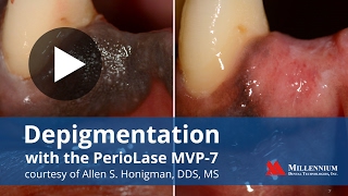 Depigmentation with the PerioLase MVP7 [upl. by Arlana]