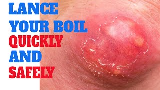 lancing a boil  How To Actually lance a boil  Pop cyst  Infectious skin warts [upl. by Hathcock]