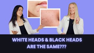 Whiteheads vs Blackheads Whats the Difference How do you treat these types of acne [upl. by Sulamith]