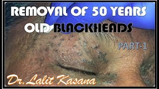 HAVING BLACKHEAD FROM LAST 50 YEARS REMOVAL BY DR LALIT KASANA [upl. by Oran106]