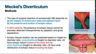 Meckels Diverticulum Wedge Excision vs Segmental Resection Anastomosis [upl. by Terrab]