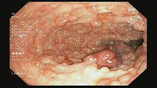 Familial Adenomatous Polyposis Coli FAP found during Colonoscopy [upl. by Ydnerb452]