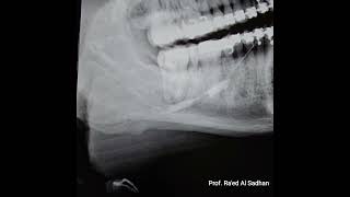 Submandibular Sialography of a Sialolith stone moving in the duct and causing partial obstruction [upl. by Lerrad487]