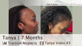 Best Female Hair Transplant Before and After  Hair Loss amp Traction Alopecia in Women Tanya [upl. by Chuah340]