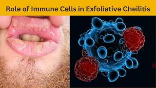 Unveiling the Role of Immune Cells in Exfoliative Cheilitis [upl. by Carlos]