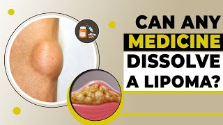 Dissolving a Lipoma With Medicine Is It Possible Lipoma Treatment in Delhi  Dr PK Talwar [upl. by Kitarp]