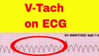 Ventricular Tachycardia on ECG [upl. by Leagiba]