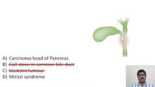 Courvoisier law in obstructive jaundice General surgery concept for NEETPG FMGE INICET NEXT [upl. by Lennad]