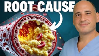 Heart Surgeon’s TRUTH about Carnivore Diet amp Cholesterol [upl. by Fleisig]