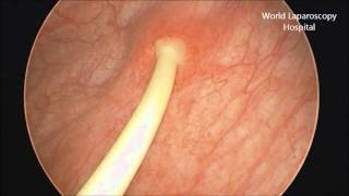 Removal of Double J stent by Cystoscopy [upl. by Atenahs]