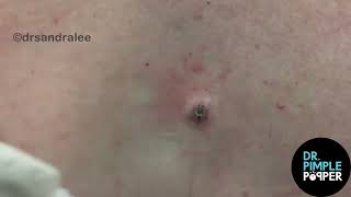 8 MINUTES OF SATISFYING POPS with Dr Sandra Lee  Dr Pimple Popper [upl. by Norek]