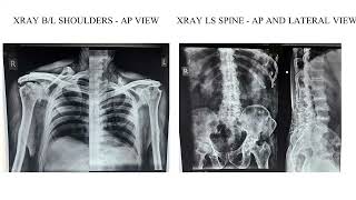 A Case of Ochronosis with Severe Bilateral Osteoarthritis Knee [upl. by Assille322]