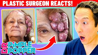 Plastic Surgeon Reacts to DR PIMPLE POPPER 100 Masses On Her Head [upl. by Ertemed]